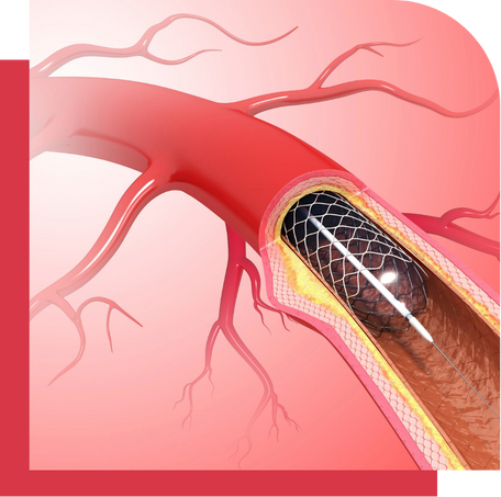 Angioplasty